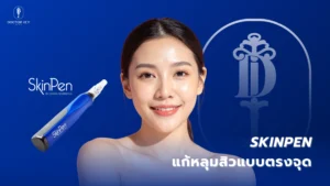 SkinPen แก้หลุมสิวตรงจุด